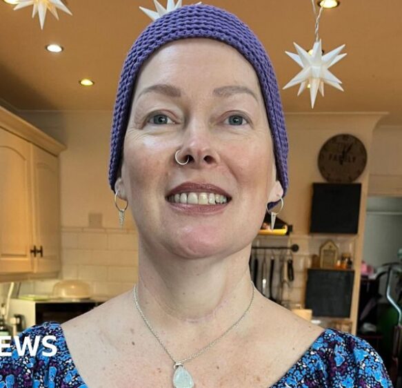 ‘My leg helped rebuild my tongue after mouth cancer diagnosis’