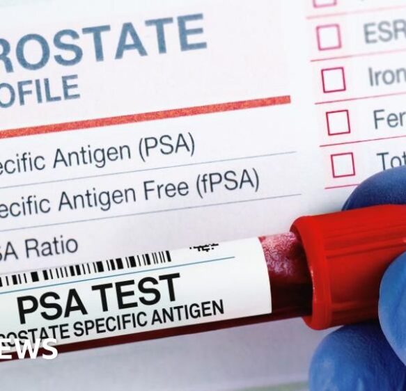 Devon group calls for more tests to screen for prostate cancer